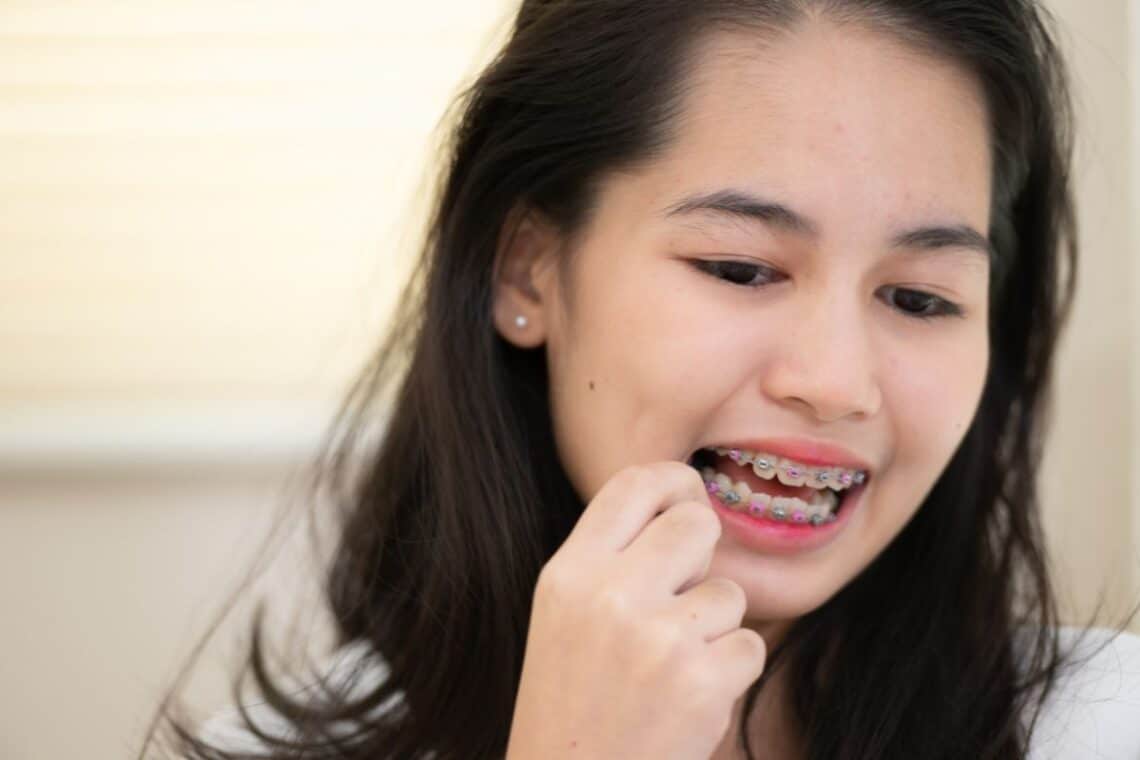 Braces in Sulphur Springs