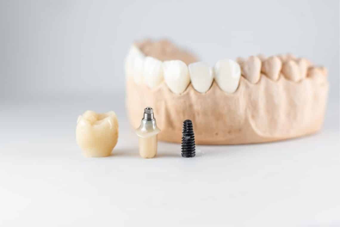 Dental Implants Suitable for Everyone