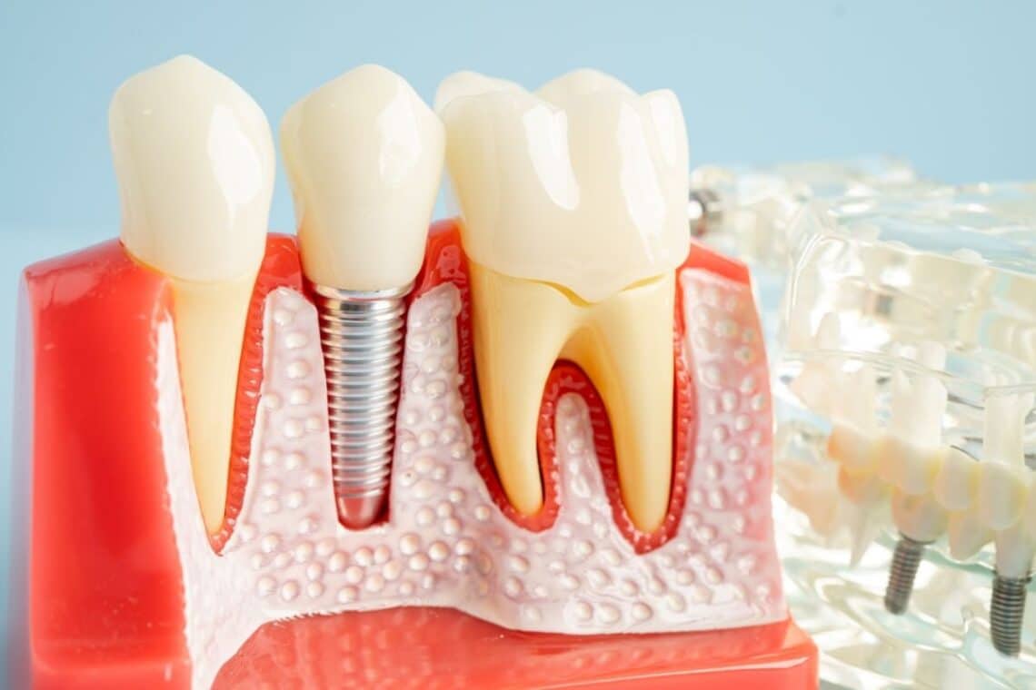 dental implants in Sulphur Springs