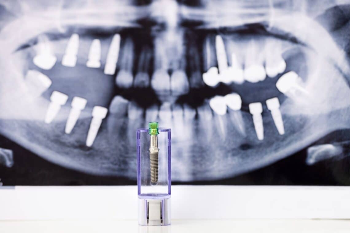 X-ray and dental implant model used by a dentist in Sulphur Springs, TX to explain the benefits of implant-supported dentures for replacing loose dentures