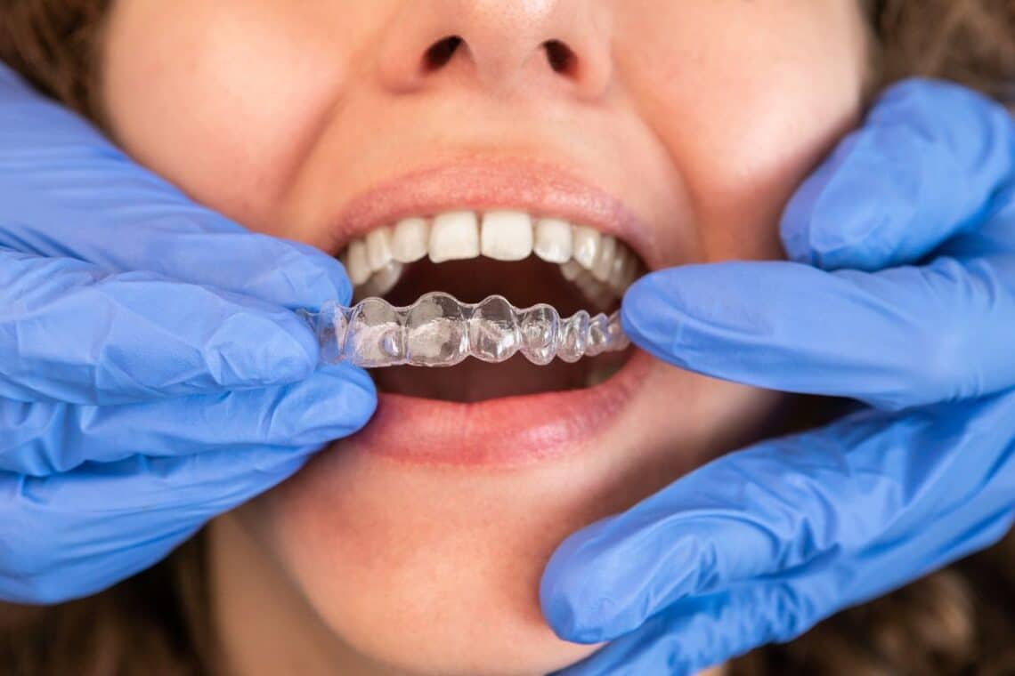 A woman in Sulphur Springs, TX wearing invisalign aligners