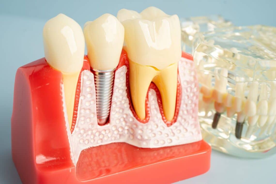 what-are-the-stages-of-getting-dental-implants-in-sulphur-springs